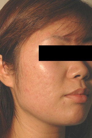 Pulsed Dye Laser Treatment for Red Acne Scars  