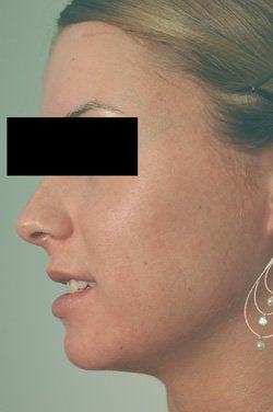 Pulsed Dye Laser Treatment for Acne/Rosacea 