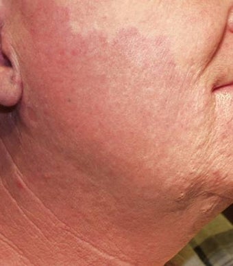 Vascular malformations or birthmarks
