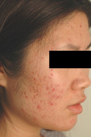 Pulsed Dye Laser Treatment for Red Acne Scars  