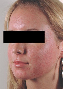 Pulsed Dye Laser Treatment for Acne/Rosacea 