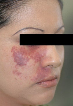 Port Wine Birthmark Removal with Pulsed Dye Lasers