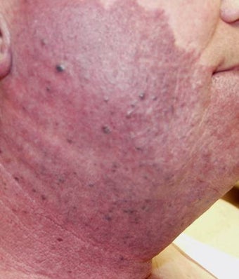 Vascular malformations or birthmarks