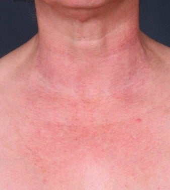 Vbeam (PDL) for chest