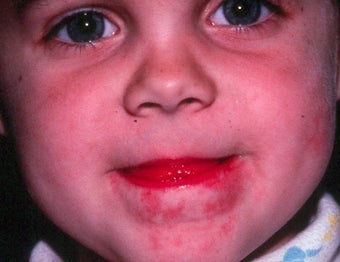 PDL for port wine stain 