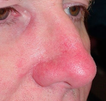 PDL for nose veins