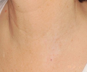 PDL for port wine stain