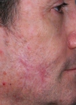 PDL scar treatment