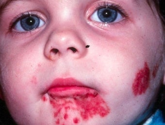 PDL for port wine stain 
