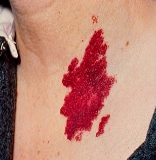 PDL for port wine stain