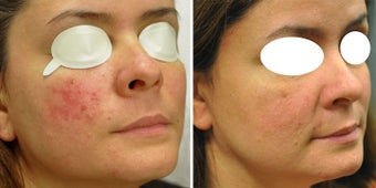 Pulsed Dye Laser for Blood Vessels