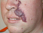 Pulsed Dye Laser