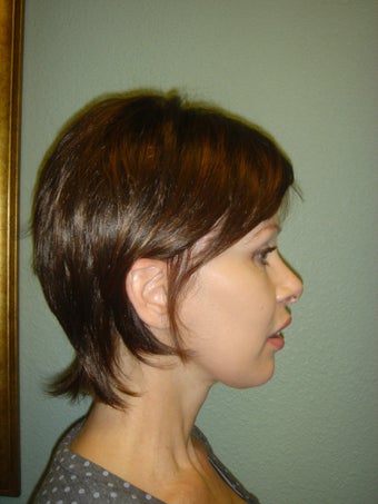 Facelift, Mini Face Lift, Quicklift