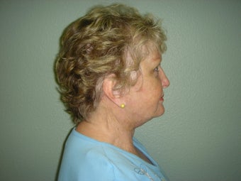 Face Lift, Quick lIft, Mini Face Lift