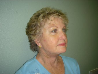 Face Lift, Quick lIft, Mini Face Lift