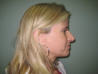 Facelift, Mini Face Lift, Quicklift