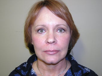 Face Lift, Quick lIft, Mini Face Lift