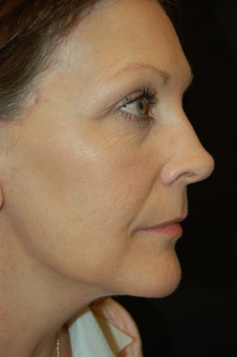 Malouf Mini-lift