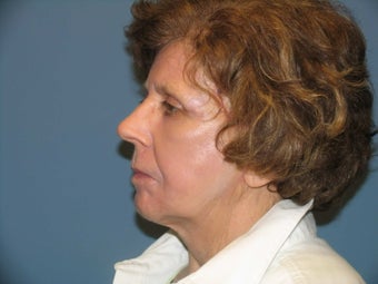 Quicklift w/neck liposuction