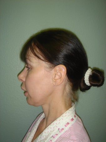 Face Lift, Quick lIft, Mini Face Lift