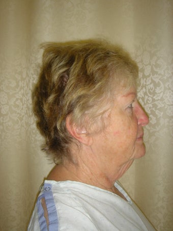 Face Lift, Quick lIft, Mini Face Lift