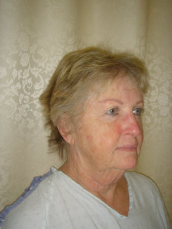 Face Lift, Quick lIft, Mini Face Lift