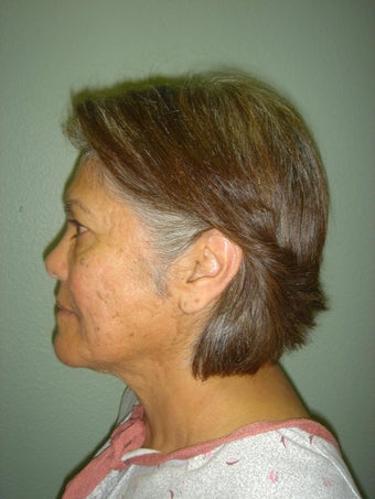 Face Lift, Quick lIft, Mini Face Lift