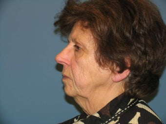 Quicklift w/neck liposuction