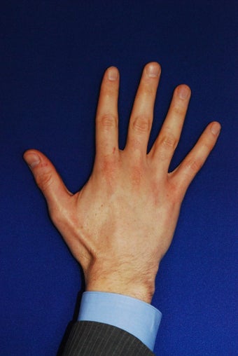 Radiesse Hand Rejuvenation