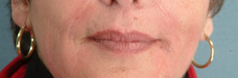 Radiesse/Juvederm