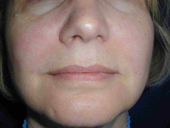 Radiesse treatment 