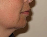 Injectables  