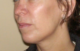 Radiesse