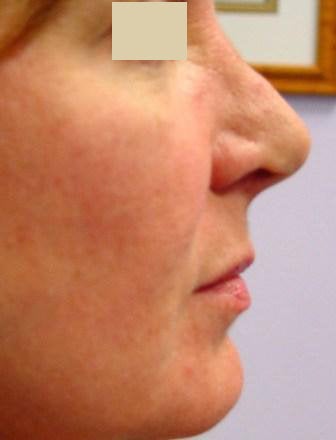 Radiesse Cheek Lift 
