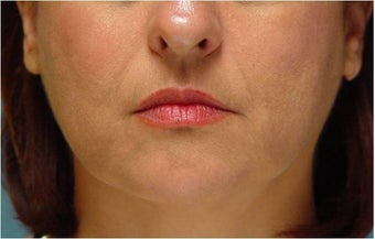 Radiesse injection nasolabial folds and marionette lines