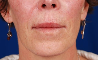 Nasolabial fold correction