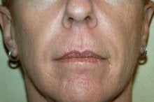 Radiesse and Juvederm XC