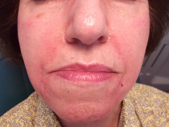Radiesse to the face/ nasolabial folds