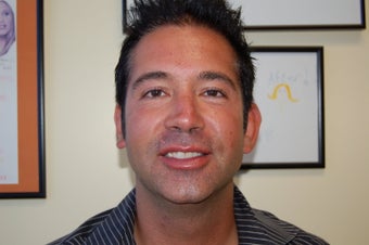 Before and After Radiesse Injections to the Cheeks and Jaw Line.