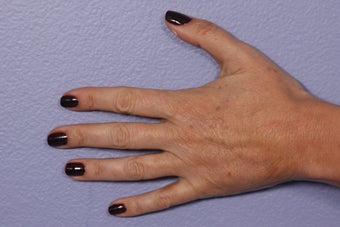 Radiesse to Hands