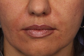 Radiesse to Smile Lines (nasolabial folds)