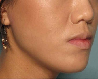 Radiesse in the chin