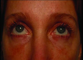 Radiesse under the eyes