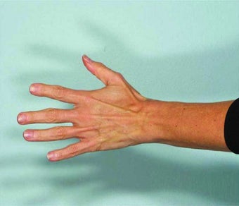 Radiesse hand rejuvenation