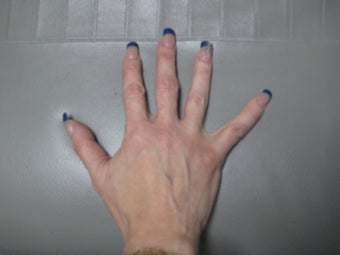 Radiesse- Hands