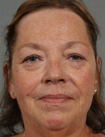 Juvederm, Radiesse, Botox