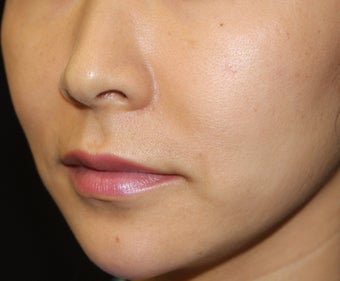 Radiesse Chin Implant / Augmentation