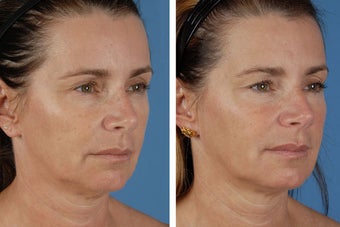 Radiesse & Botox Cosmetic