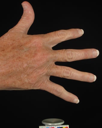 Hand Rejuvenation 