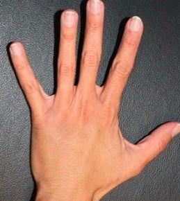 Hand rejuvenation